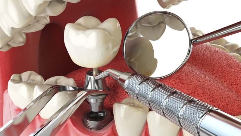 Tra Le Fasi Impianto Dentale, L'inserimento Protesico è Il Momento Topico